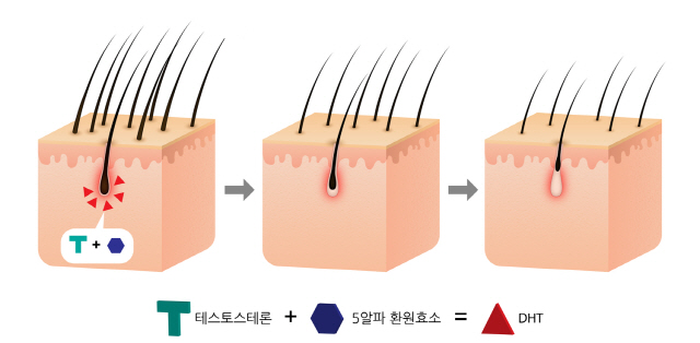 탈모예방은 샴푸보다 먹는 약이 더 효과적이라던데...